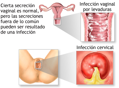 Estudio de la paciente ginecológica-leucorrea