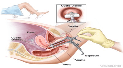 Procedimientos diagnósticos en ginecología-legrado