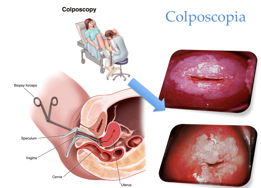 Procedimientos diagnósticos en ginecología-colposcopia