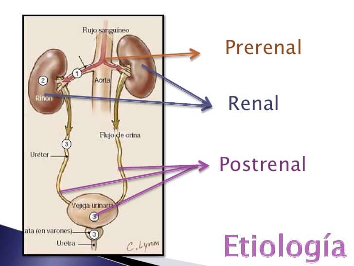 Falla renal aguda y sus tres tipos | Salud