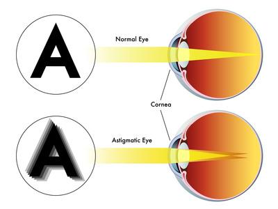 astigmatismo 31