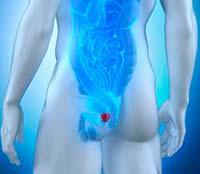 cánceres más mortíferos