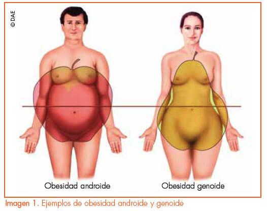Obesidad-ginecoide-androide