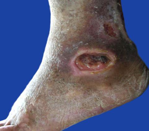 Úlceras por presión en pacientes geriátricos