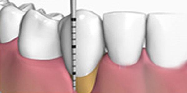 tratamiento para la periodontitis