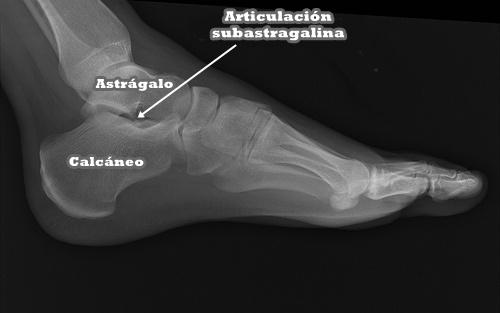 Articulación subastragalina