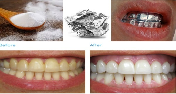 Coloca papel de aluminio en tus dientes durante 1 hora y mira el  resultado... | Belleza