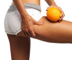 Cellulite