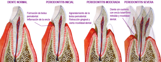 periodontitis