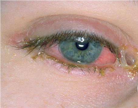 conjuntivitis 0033