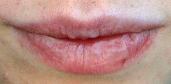 labios agrietados