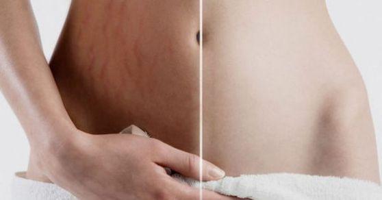 estrias y manteca de cacao