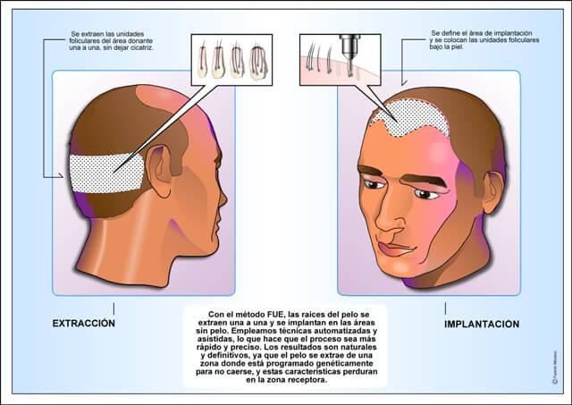 Implante capilar para la caída de cabello