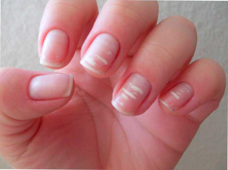 Soluciones para las manchas blancas de las uñas