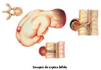 Espina bífida. Ácido fólico