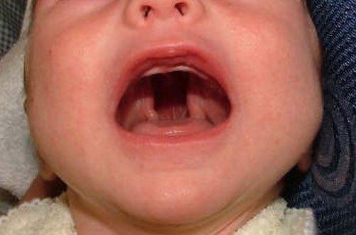 Paladar hendido. Ácido fólico