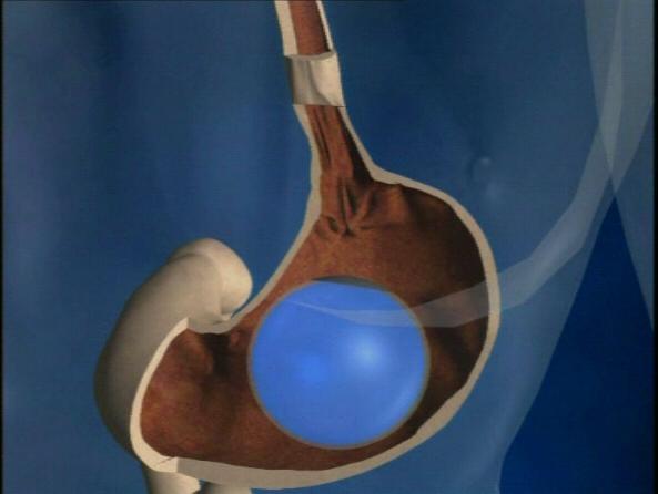 tratamiento con balón intragástrico en madrid