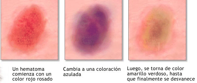 Golpes Y Hematomas ¡actúa Lo Antes Posible Salud