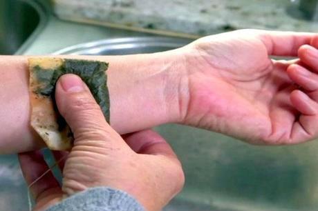 que sirve para una quemadura