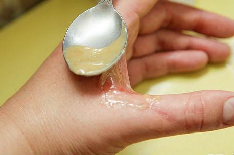 remedios caseros para las quemaduras