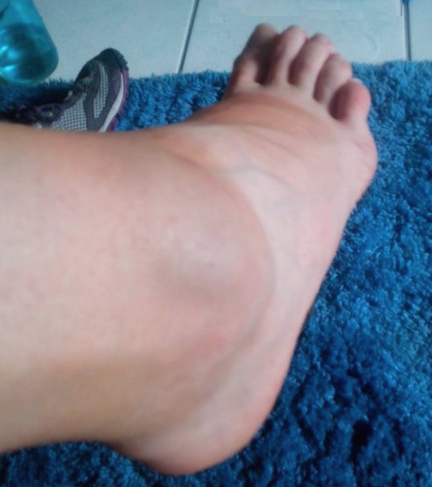 riesgos de padecer alzheimer