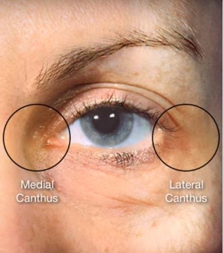 blefaroplastia cantopexia
