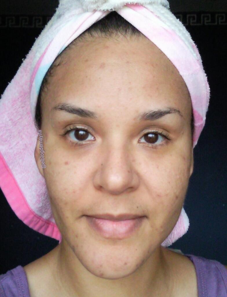 acne-manchas-cicatrices-piel-grasa-espinillas-barros