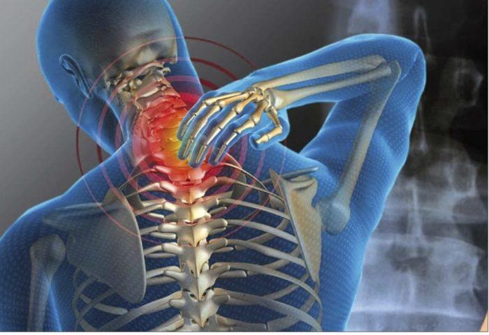 contractura cervical
