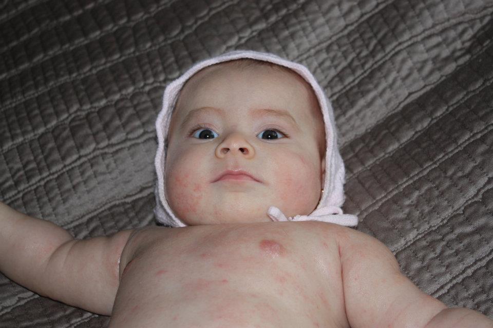 Cómo detectar alergias alimentarias en bebes signos y síntomas