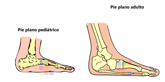 Pie plano pediatrico-adulto