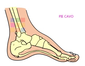 Pie cavo