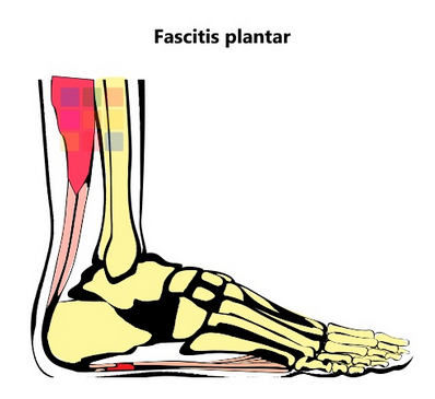 fascitis plantar