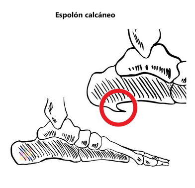 espolon calcaneo