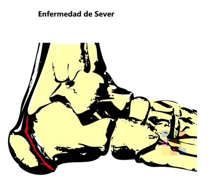 Enfermedad Sever
