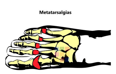 Metatarsalgias