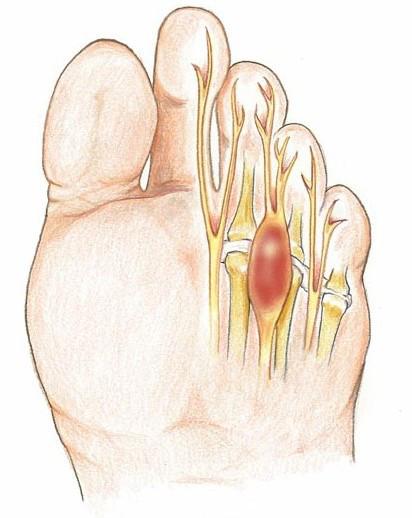 neuroma-morton-lesion