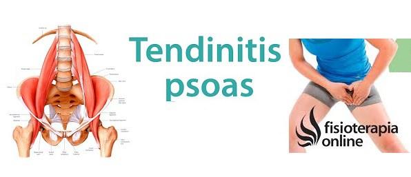 Tendinitis del Músculo iliopsoas