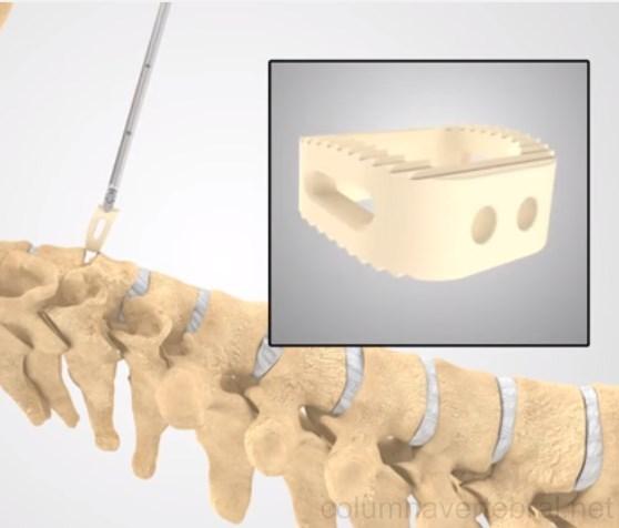 La artrodesis vertebral, es un tipo de cirugía cuya función es fusionar dos o más vértebras