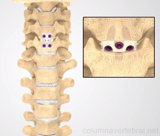 artrodesis_vertebral