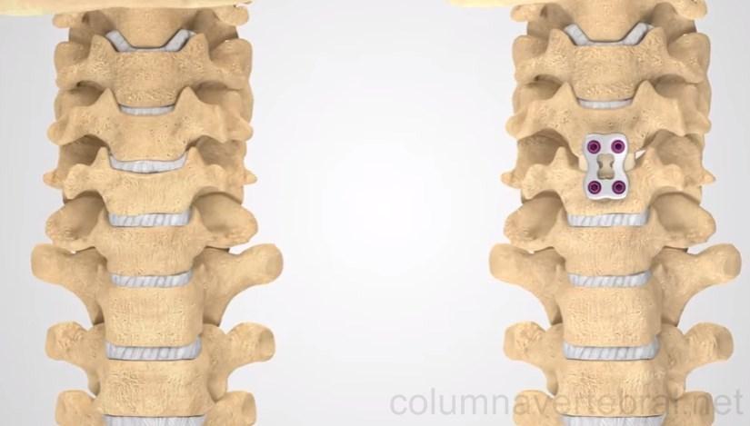 artrodesis-vertebral_