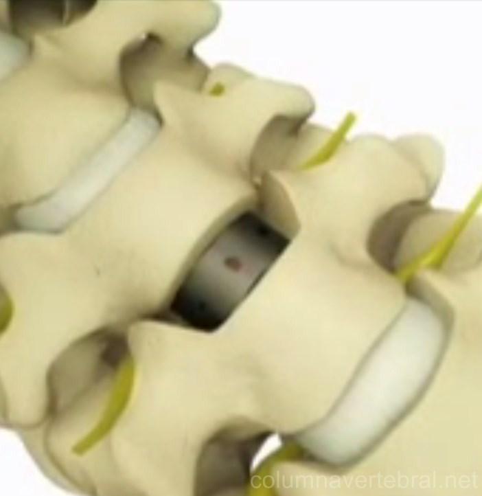 La discectomía o disquectomía es un tipo de cirugía que busca la extirpación total o parcial de una hernia discal