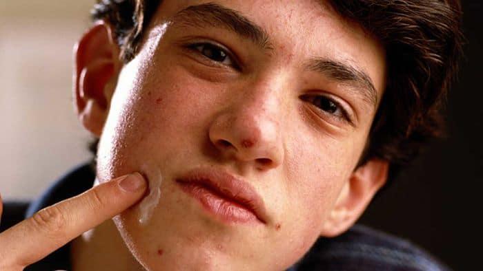 Acné en un culturista 