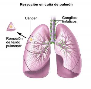 Resección en cuña en cáncer pulmonar
