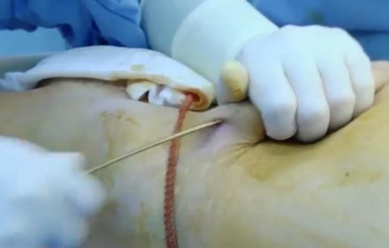 Procedimiento para realizar el lipofilling