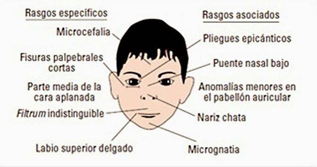 trastorno de alcoholismo fetal