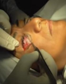 blefaroplastia transcutánea