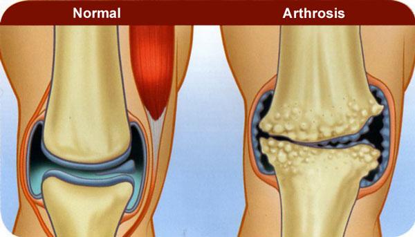 artrosis y artritis