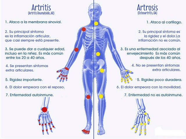 artritis-y-artrosis