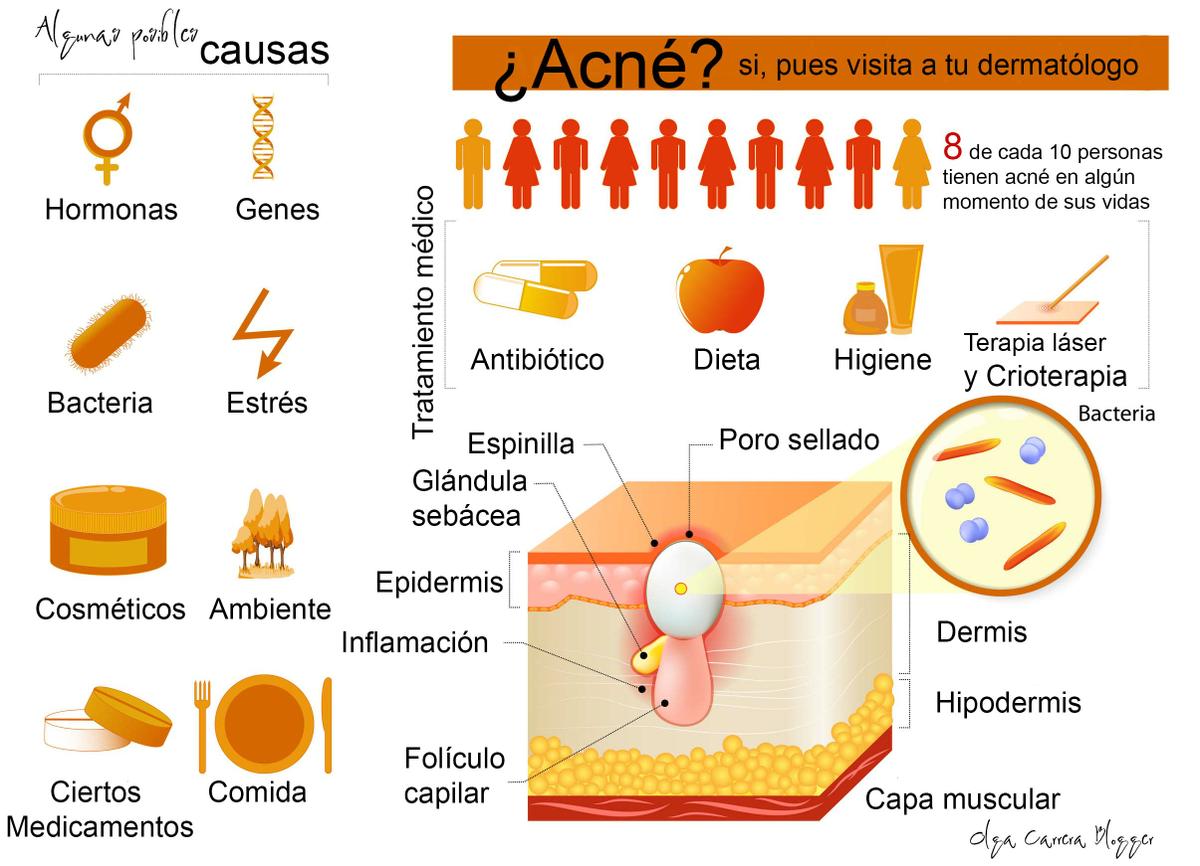 Causas Del Acné Belleza