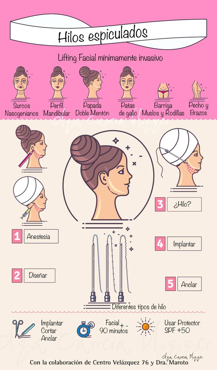 Infografía hilos espiculados reabsorbibles por Olga Carrera Blogger